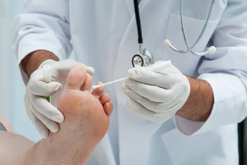 Če imate simptome glivic na nohtih, se morate posvetovati z dermatologom ali mikologom. 