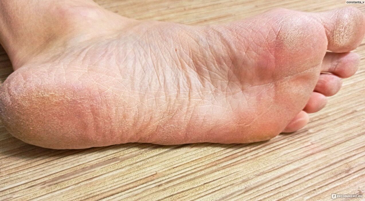 glivice na človeški nogi